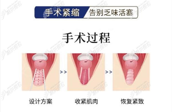 传统缩阴手术过程图片