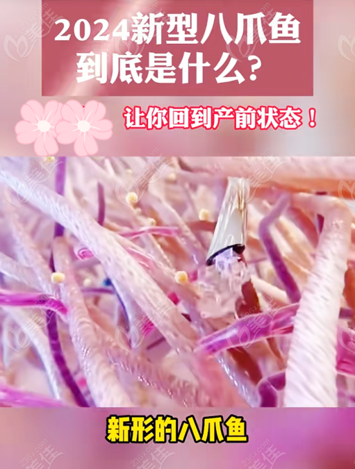 什么是八爪鱼紧缩术看这里！八爪鱼紧缩术和3d生物束带原理不一样