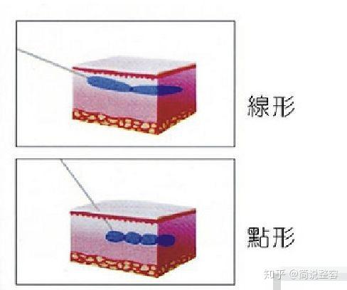 生物去皱是不是就是肉毒素_生物除皱的价钱_生物去皱是什么