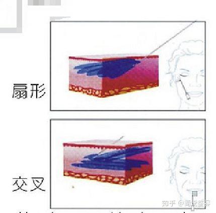 生物去皱是什么_生物除皱的价钱_生物去皱是不是就是肉毒素