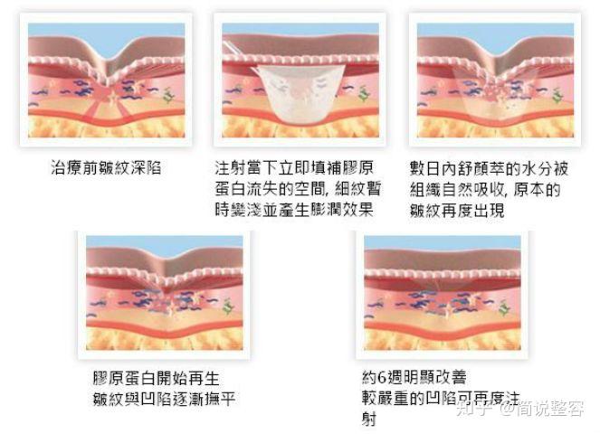 生物去皱是什么_生物除皱的价钱_生物去皱是不是就是肉毒素