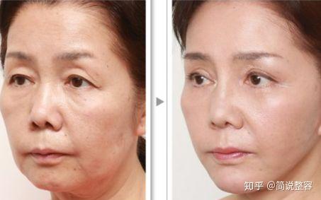 生物去皱是不是就是肉毒素_生物除皱的价钱_生物去皱是什么