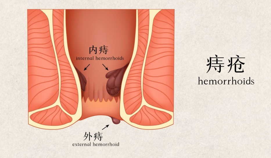肛门生物赘长怎么治疗_肛门长一个赘生物_肛门赘生物能治好吗