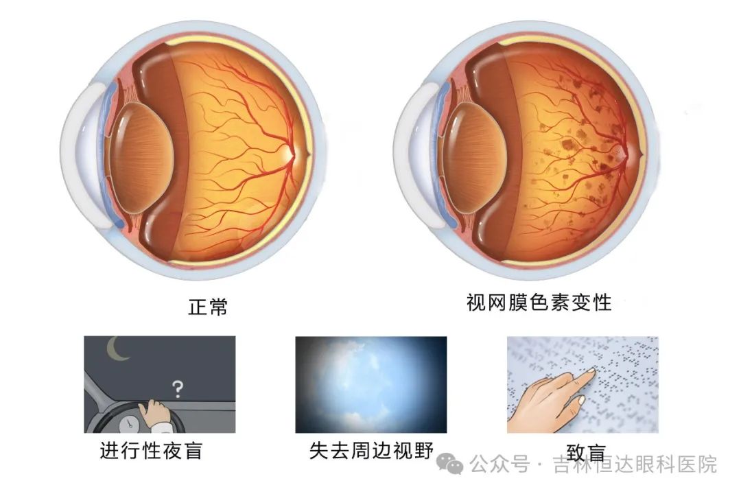 浅谈视网膜色素变性的治疗