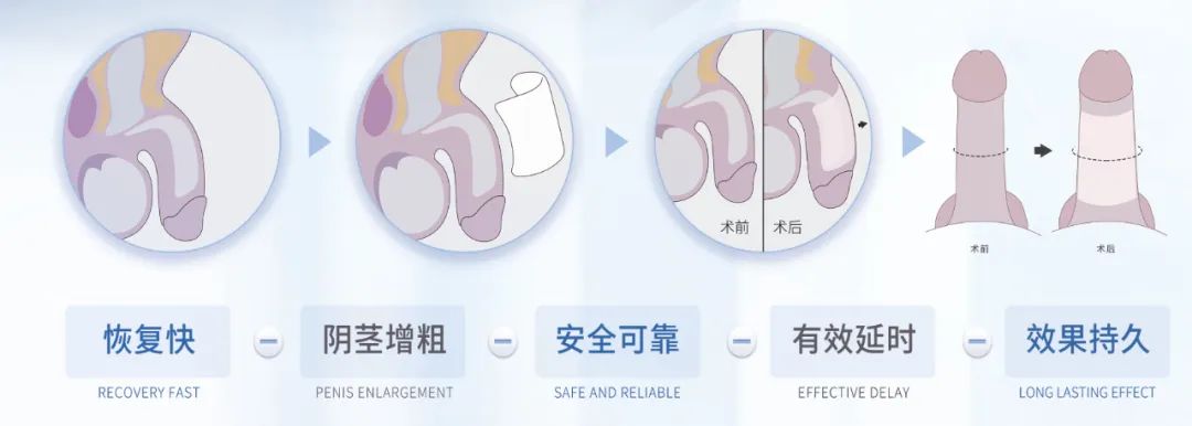 男人坚持时间太短？ADM-H内置生物套技术增粗+延时   提高男性生活质量