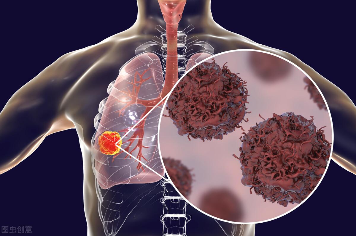 肉瘤生物治疗_治疗肉瘤有效的药物_生物治疗肿瘤怎么样