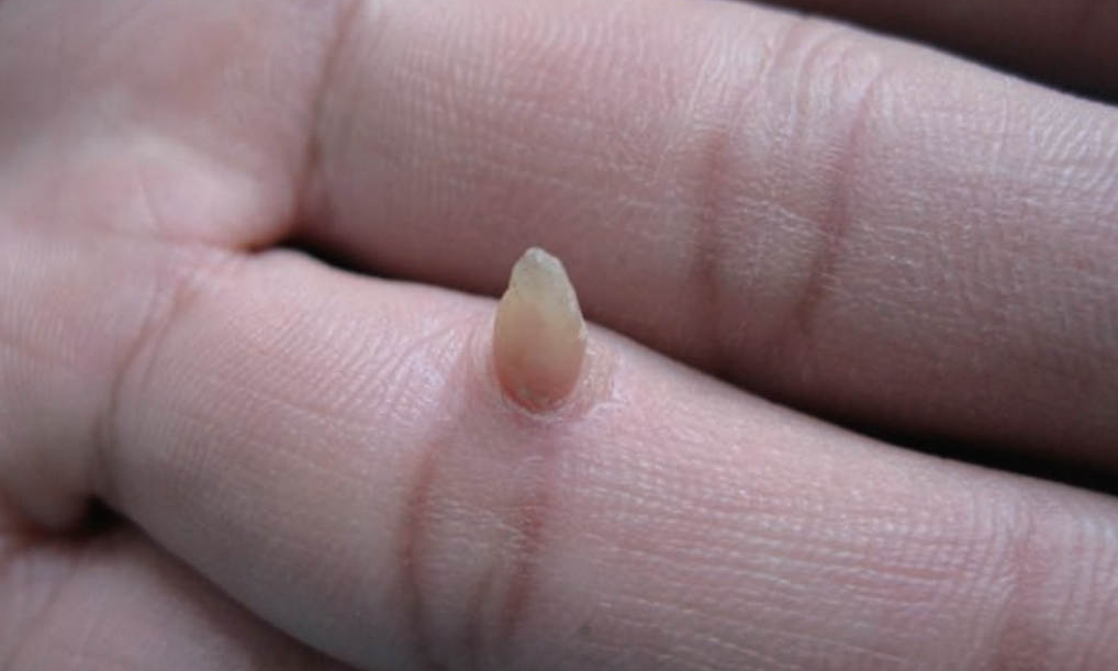 赘生物长大_长赘生物是什么_生物赘生物