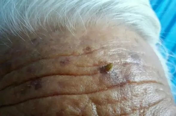 赘生物长大_长赘生物是什么_生物赘生物