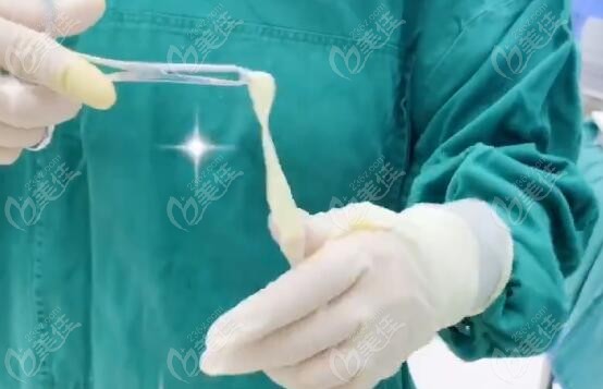 3d生物束带是什么材料？3d生物束带紧缩术做了三年了还能取出来吗？