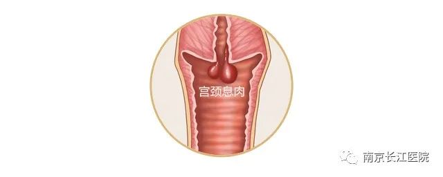 恶性宫颈赘生物图片_宫颈赘生物良性多还是恶性多_宫颈赘生物什么样子是良性