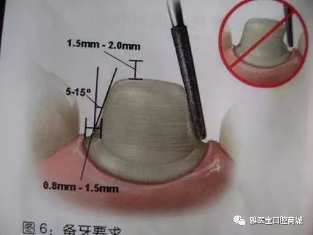 生物烤瓷牙费用_生物烤瓷牙含金属吗_生物性烤瓷牙